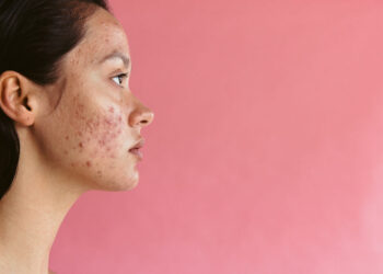 Bad habits that trigger acne