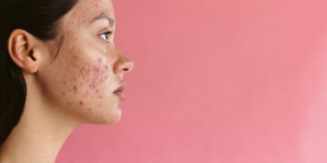 Bad habits that trigger acne